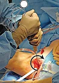 قطع عظم الحرقفة بدقة متناهية