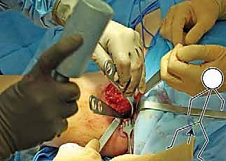 مقارنة الخيارات العلاجية لخلل التنسج