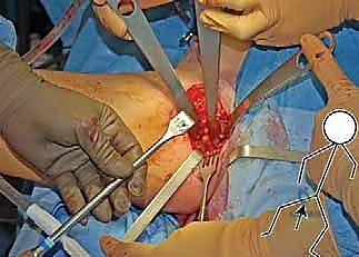 استخدام التقنيات الحديثة في جراحة العظام