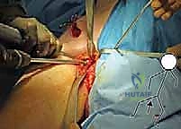 استخدام العكازات لتخفيف الوزن على المفصل