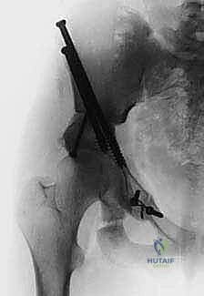 تحسن ميكانيكا المشي بعد التداخل الجراحي الناجح