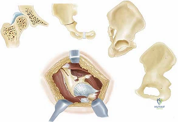 تخطيط جراحة كياري بالأشعة السينية لتقييم خلل التنسج الوركي