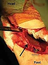Illustration of chiari medial displacement - Dr. Mohammed Hutaif