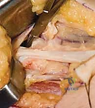 صورة توضيحية لـ جراحة نقل الأوتار لشلل العصب الأوسط: استعادة وظيفة اليد وحياة طبيعية
