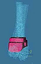 صورة شعاعية توضح الاحتكاك العظمي في الكاحل