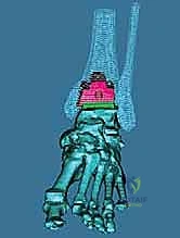 التشوهات المصاحبة لخشونة الكاحل