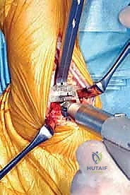 التشريح الدقيق لمفصل الكاحل وعلاقتها بالمفصل الصناعي