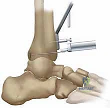 مكونات نظام TNK لاستبدال مفصل الكاحل