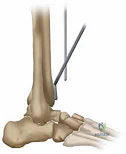استبدال مفصل الكاحل الكلي بنظام TNK لعلاج خشونة الكاحل المتقدمة