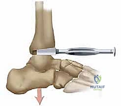 صورة توضيحية لـ استبدال مفصل الكاحل الكلي بنظام TNK لعلاج خشونة الكاحل المتقدمة