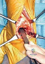 صورة توضيحية لـ استبدال مفصل الكاحل الكلي بنظام TNK لعلاج خشونة الكاحل المتقدمة