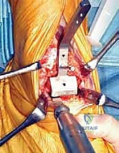 استخدام مرشدات القطع العظمي الدقيقة