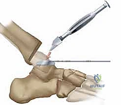 مقارنة بين المفصل الطبيعي والمفصل الصناعي