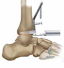 صورة توضيحية لـ استبدال مفصل الكاحل الكلي بنظام TNK لعلاج خشونة الكاحل المتقدمة