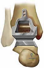 صورة توضيحية لـ استبدال مفصل الكاحل الكلي بنظام TNK لعلاج خشونة الكاحل المتقدمة