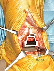 صورة طبية: استبدال مفصل الكاحل الكلي بنظام TNK لعلاج خشونة الكاحل المتقدمة
