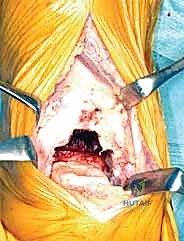 صورة توضيحية لـ استبدال مفصل الكاحل الكلي بنظام TNK لعلاج خشونة الكاحل المتقدمة