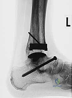 صورة طبية: استبدال مفصل الكاحل الكلي بنظام TNK لعلاج خشونة الكاحل المتقدمة