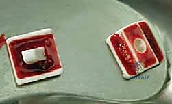 صورة توضيحية لـ استبدال مفصل الكاحل الكلي بنظام TNK لعلاج خشونة الكاحل المتقدمة