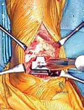 صورة توضيحية لـ استبدال مفصل الكاحل الكلي بنظام TNK لعلاج خشونة الكاحل المتقدمة