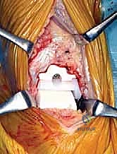 صورة طبية: استبدال مفصل الكاحل الكلي بنظام TNK لعلاج خشونة الكاحل المتقدمة