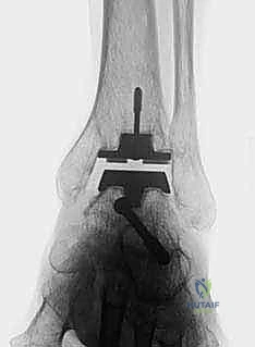 صورة طبية: استبدال مفصل الكاحل الكلي بنظام TNK لعلاج خشونة الكاحل المتقدمة