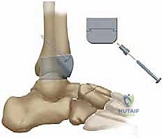 صورة توضيحية لـ استبدال مفصل الكاحل الكلي بنظام TNK لعلاج خشونة الكاحل المتقدمة