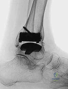 التخطيط المسبق وتحديد المحاور العظمية