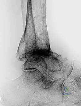 الشق الجراحي الأمامي للكاحل