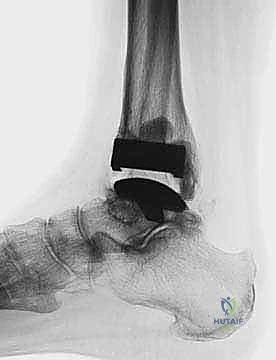 FIG 6 The TNK ankle replacement for rheumatoid arthritis of the ankle cemented replacement