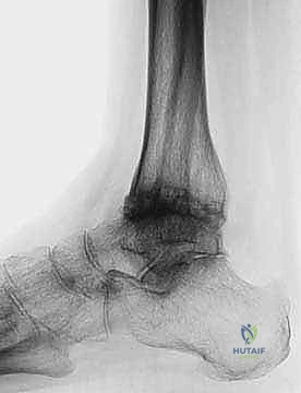 TNK Total Ankle Arthroplasty: An Intraoperative Masterclass for End-Stage Ankle Arthritis