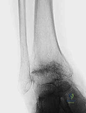 FIG 6 The TNK ankle replacement for rheumatoid arthritis of the ankle cemented replacement