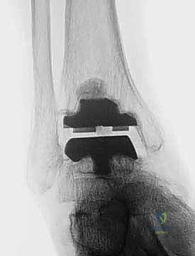 FIG 6 The TNK ankle replacement for rheumatoid arthritis of the ankle cemented replacement