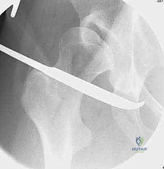 Bernese Periacetabular Osteotomy: A Masterclass in Hip Preservation