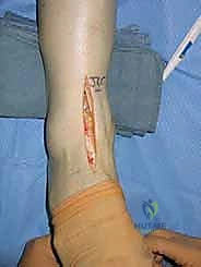 نظام مفصل الكاحل Agility