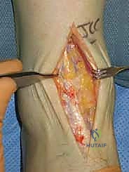 خيارات علاج الكاحل الجراحية