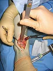 زراعة مفصل الكاحل الصناعي
