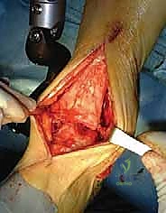 الشق الجراحي والوصول للكاحل