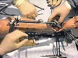 التخطيط الجراحي لعملية الكاحل