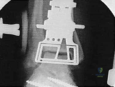 تحضير العظام لزراعة المفصل