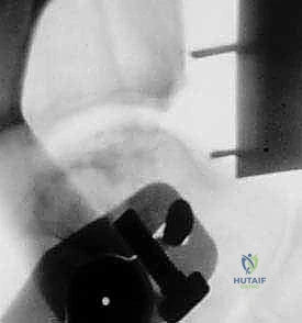 صورة توضيحية لـ استبدال مفصل الكاحل الكلي Agility: حل دائم لآلام الكاحل المزمنة في صنعاء مع الأستاذ الدكتور محمد هطيف