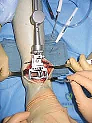 إغلاق الجرح بعد عملية الكاحل