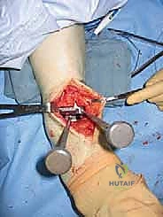 صورة توضيحية لـ استبدال مفصل الكاحل الكلي Agility: حل دائم لآلام الكاحل المزمنة في صنعاء مع الأستاذ الدكتور محمد هطيف