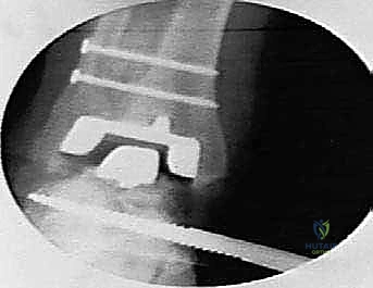 صورة توضيحية لـ استبدال مفصل الكاحل الكلي Agility: حل دائم لآلام الكاحل المزمنة في صنعاء مع الأستاذ الدكتور محمد هطيف