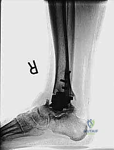 صورة طبية: مراجعة مفصل الكاحل الصناعي (Agility) وعلاج كسور الكعب: دليل شامل للمرضى