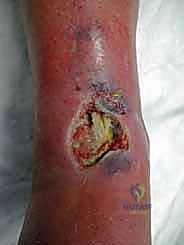 صورة طبية: مراجعة مفصل الكاحل الصناعي (Agility) وعلاج كسور الكعب: دليل شامل للمرضى