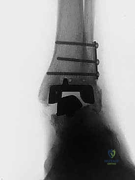 صورة طبية: مراجعة مفصل الكاحل الصناعي (Agility) وعلاج كسور الكعب: دليل شامل للمرضى