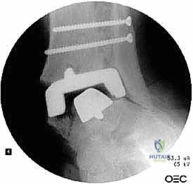 صورة طبية: مراجعة مفصل الكاحل الصناعي (Agility) وعلاج كسور الكعب: دليل شامل للمرضى
