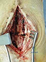 موضع الكعب الداخلي والخارجي