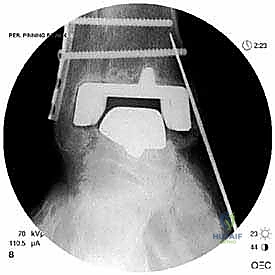توضيح تشريحي للكاحل